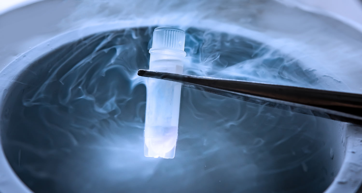 Preservação de fertilidade – a criopreservação de ovócitos